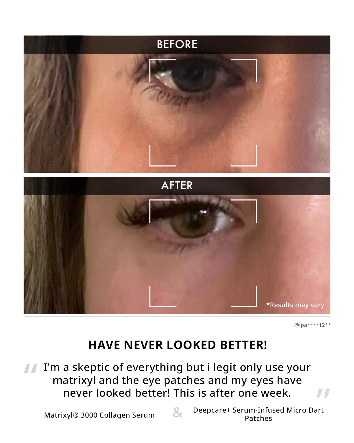 Before and after comparison of eye area with Matrixyl 3000 Collagen Serum and Deepcare Serum-Infused Micro Dart Patches.