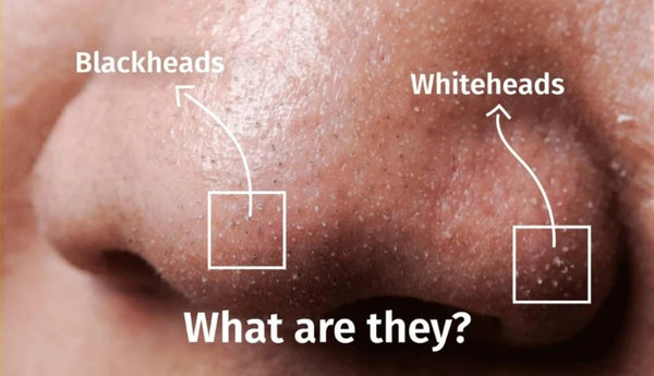 What Are Whiteheads And How To Get Rid Of Them?