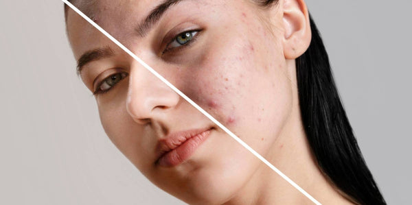 What Does Sensitive Skin Mean? : Explained