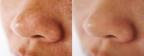 How Do Blackheads Form?: Explained