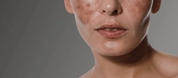 Melasma vs. Hyperpigmentation: Differences & Treatments