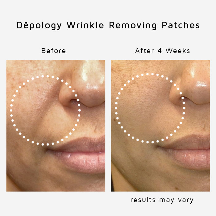 Anti-Wrinkle Eye and Smile Microneedle Patches